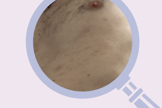 Case of the month: What is wrong with this middle-aged man with pityriasis rosea?