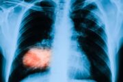 Under the radar: Lung cancer in non-smokers