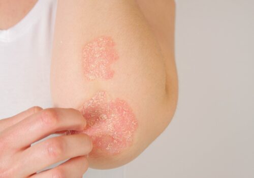 Study suggests biologics safe for pregnant women with psoriasis