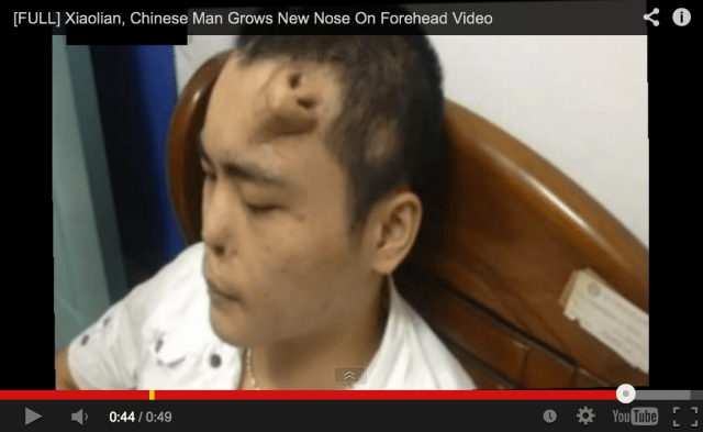 Chinese man loses his nose in an accident, has new one artificially grown on his forehead