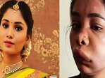 Pictures of Kannada actress Swathi Sathish go viral after her root canal surgery goes wrong