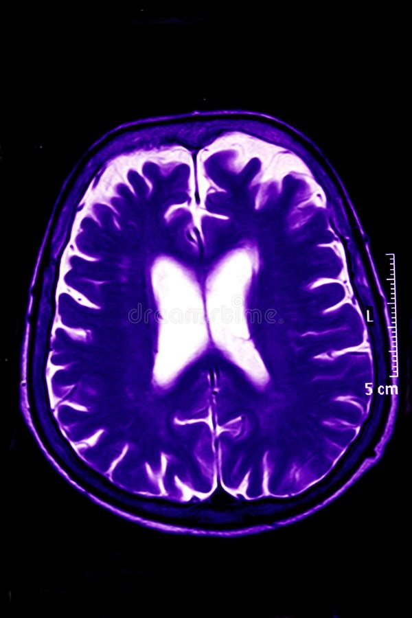 Magnetic Resonance of Brain, blue stock photos