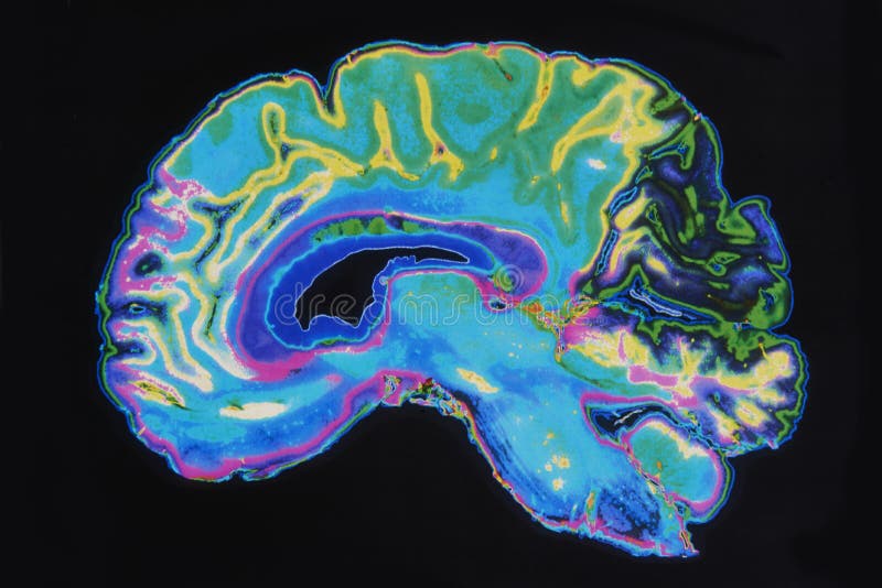 Colorized MRI Image Brain On Black Background. Colorized MRI Image Brain On Black Background