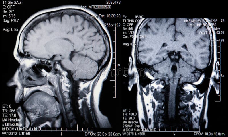 Dual View of Real MRI Scans of the Head and Brain