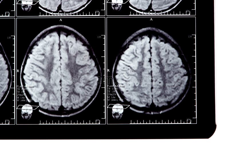 X-ray image of the brain stock photos