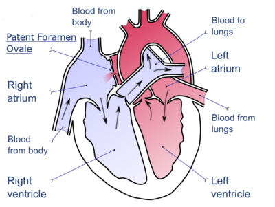 A drawing depicting a patent foramen ovale