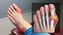 A medical illustration showing the joint of the big toe being affected by gout