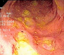 Image of deep ulcers in the colon of a person with Crohn's colitis.