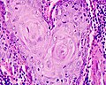 Carcinoma planoepithelial del larynge.