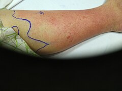 Left cellulitis of leg.jpg