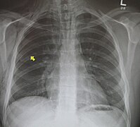 PneumoMediastinum2008.jpg