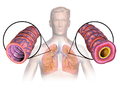 Diagram of asthma