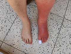 Cellulitis Left Leg.JPG