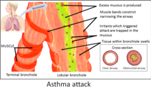 The image of an asthmatics airway.