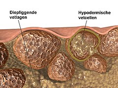 Cellulitis Dutch text.jpg