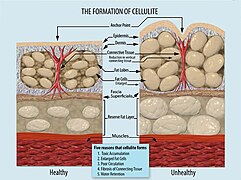 Formation of Cellulite.jpg