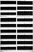 Sphygmographic traces. Wellcome M0018837.jpg