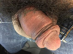 Penile edema.jpg