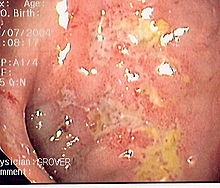 Image of a serpiginous ulcer due to Crohn's disease found during a colonoscopy.