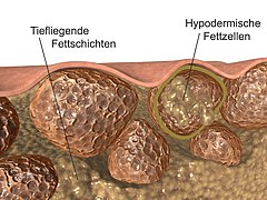 Cellulitis.jpg