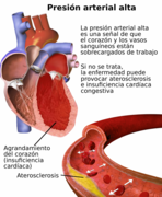 Blausen 0486 HighBloodPressure 01-es.png