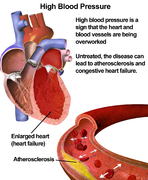 Blausen 0486 HighBloodPressure 01.png