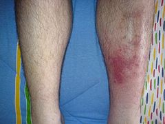 Cellulitis1.jpg