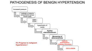 Pathogenesis of Benign Hypertension.png