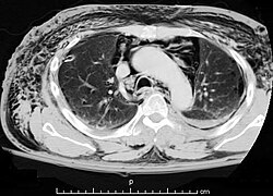 Subcutaneous emphysema chest cropped.jpg