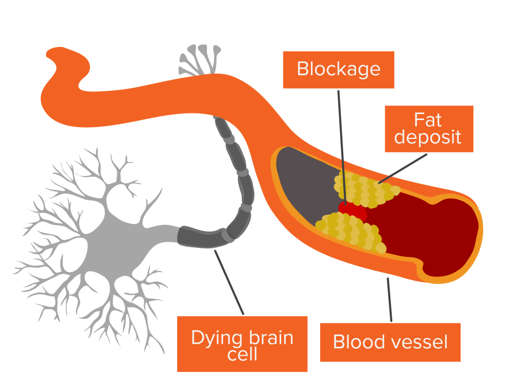 A diagram of a blood vessel with a fat deposit that blocks blood reaching neurons. The neuron is grey and dying because of the lack of oxygen and nutrients.