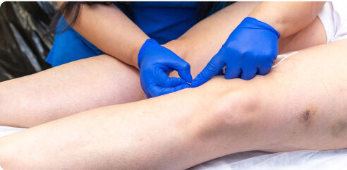 Treating Varicose Veins