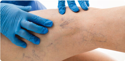 Treating Spider Veins