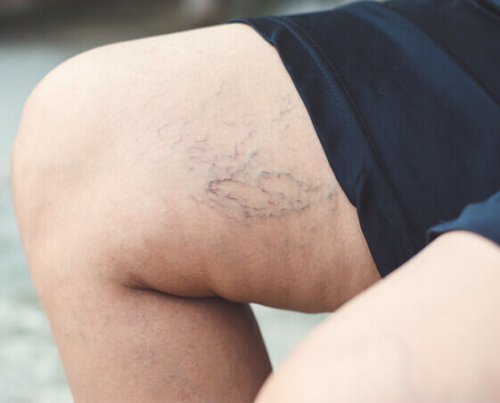 Spider Veins Navigation