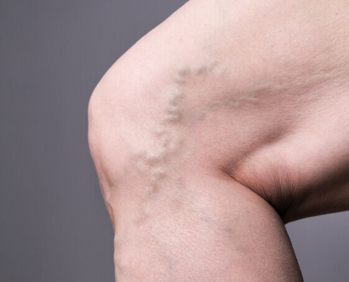 Varicose Veins Navigation