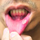 Why Do I Keep Getting Canker Sores in My Mouth?