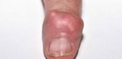 Gout increases the risk of multiple diseases