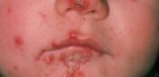 CPD: Case by case – managing common skin infections in primary care