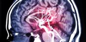 Study finds ‘clear correlation’ between AF and risk of vascular dementia