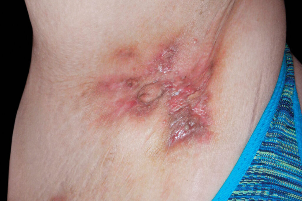 Hidradenitis_suppurativa_of_the_armpits