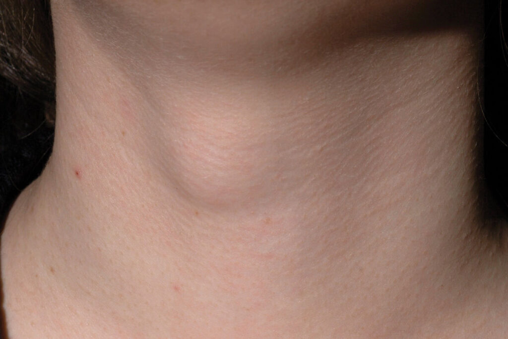 Thyroglossal_cyst