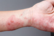 Speediatrics: Can you solve this quick case of a child’s rash?