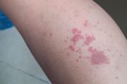 Speediatrics: Can you solve this quick case involving a lower-limb rash?