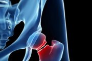 Patients with hip fractures face long waits for rehab