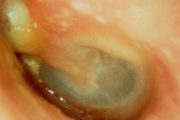 How not to miss cholesteatoma