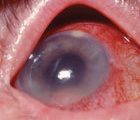 Cataract surgery complications (1 CPD hour)