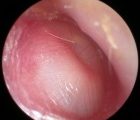 Glue ear – The information (0.5 CPD hours)