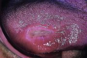 Picture quiz – oral ulcers