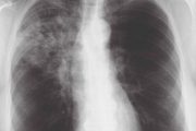 Guideline of the month: Community-acquired pneumonia