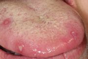 The information – Aphthous ulcers