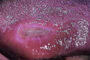 Picture quiz – oral ulcers